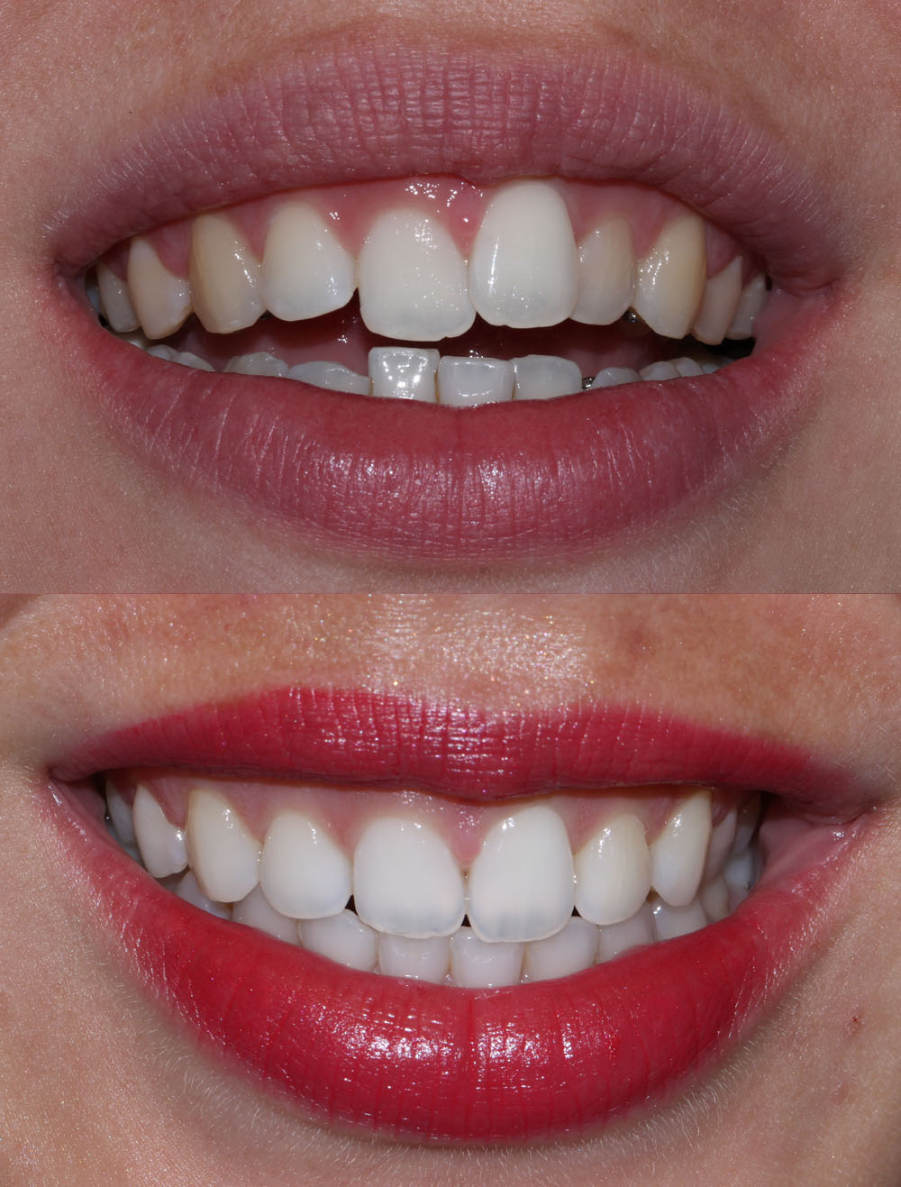 lingual braces before after