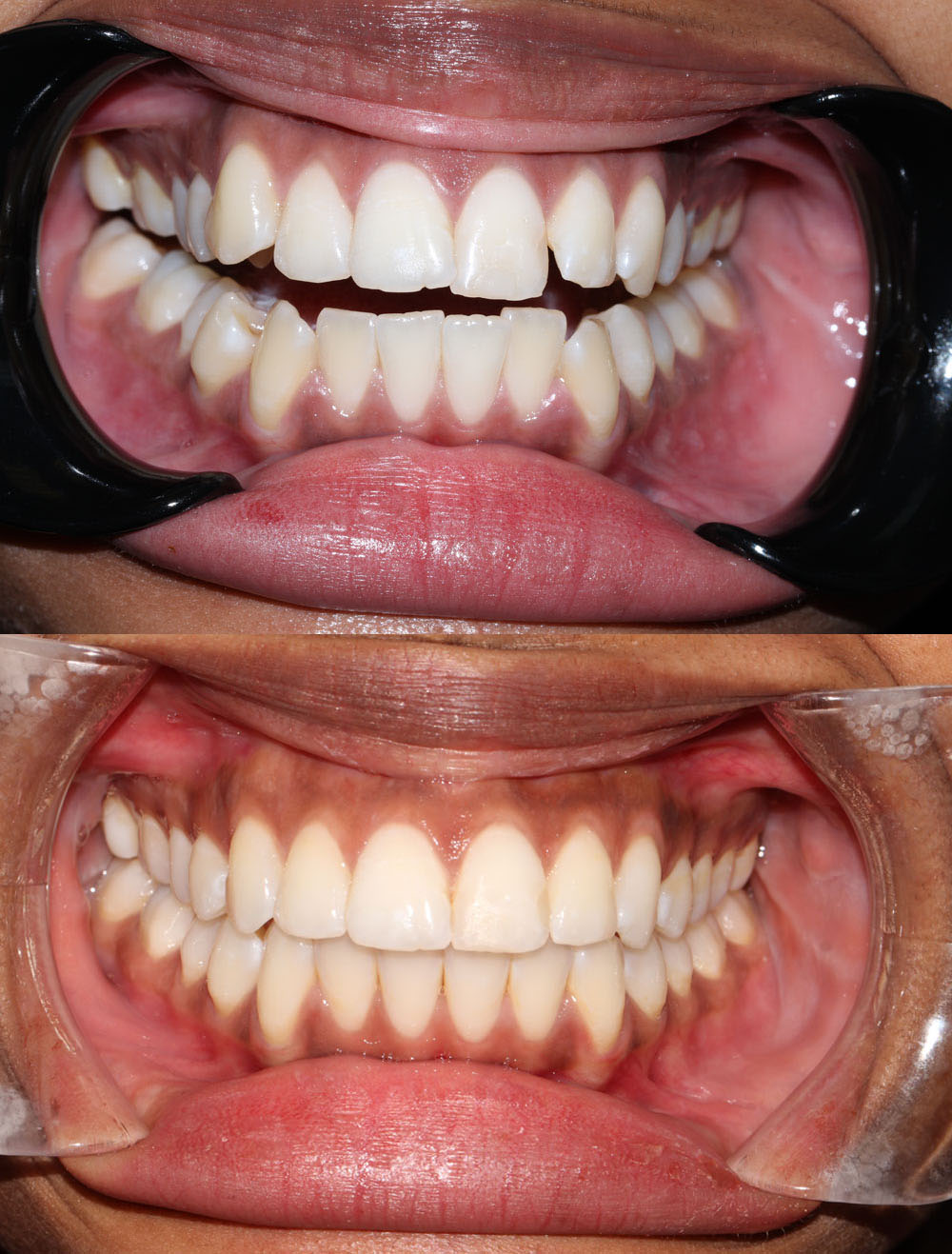 invisalign clear aligners before and after
