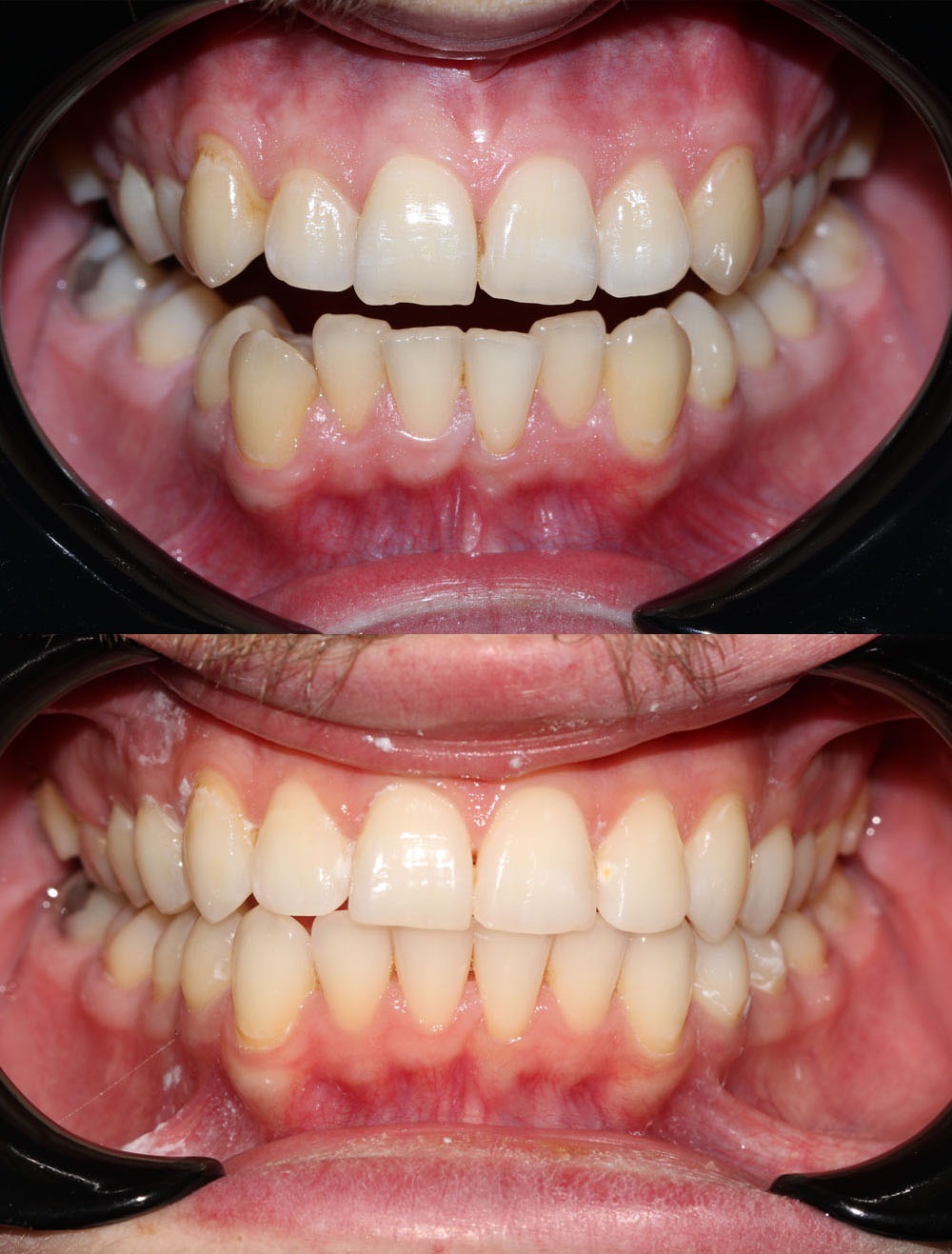 invisalign clear aligners before and after